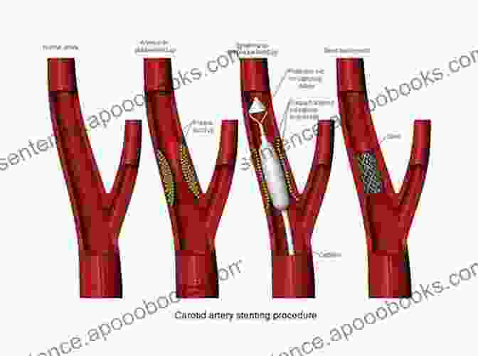 Practical Carotid Artery Stenting: The Essential Guide For Interventionalists Practical Carotid Artery Stenting Ronan Hession